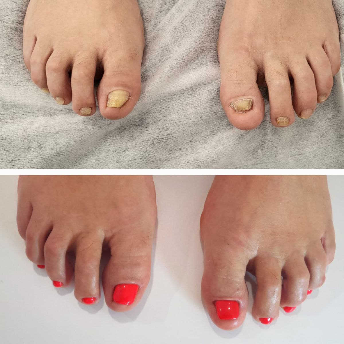 Reconstrucción de uñas